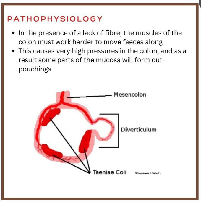 Diverticulitis II