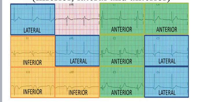 ECG:(1) Lead I +aVL+V5-6.....lateral(LCA).           (2)lead II +III+aVF...inferior.....Inferior(RCA).             (3)V1-V4.....anterior(Anterior descending artey).       ***consider posterior MI look to lead V1-V3 if ST depression and tall R.                                                          ****consider RV infract if ST elevation in V4R association with inferior MI