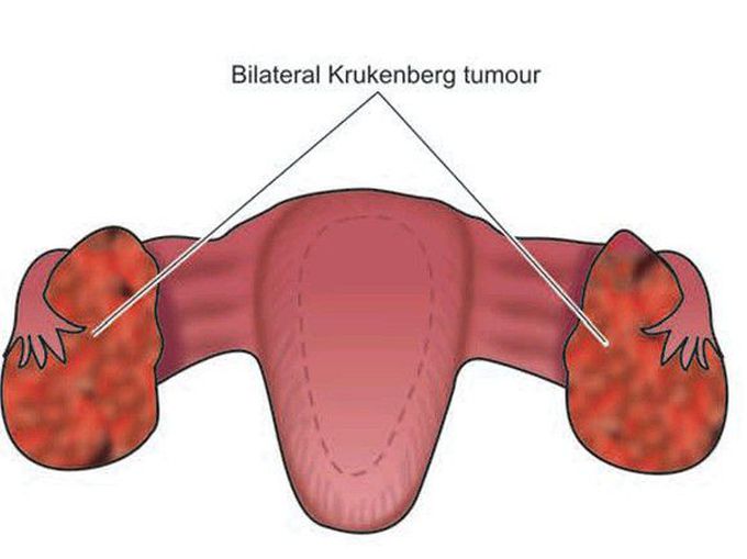 Krukenberg tumour