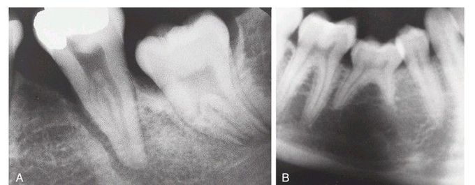 Periodontal disease