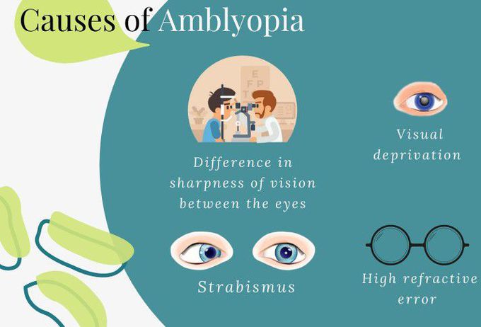 Causes of Amblyopia