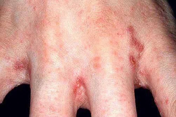 Scabies interdigital