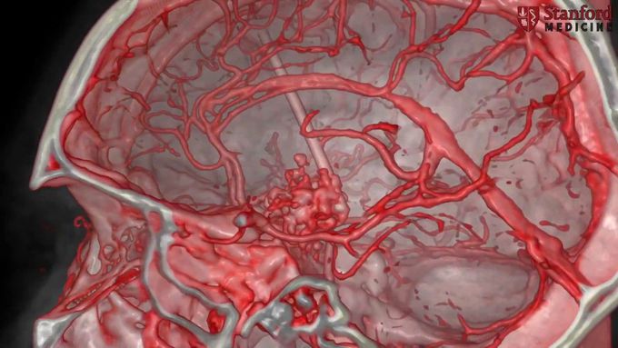 Removal of Giant Pediatric Craniopharyngioma at Stanford