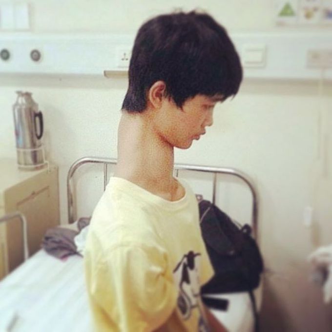 10 cervical vertebrae instead of 7
