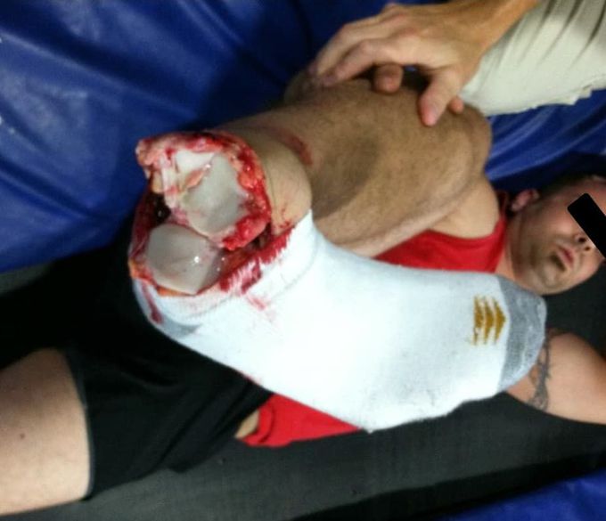 Inversion injury to his right ankle after a failed landing on a trampoline.