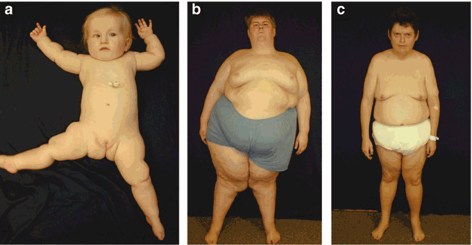 Treatment for Prader-Willi syndrome