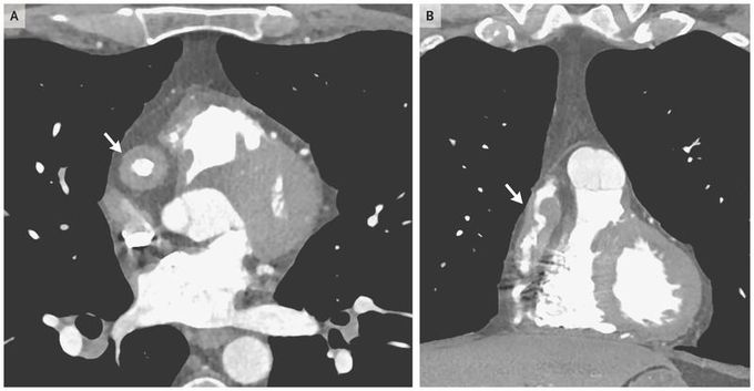 Coronary Arteritis in IgG4-Related Disease