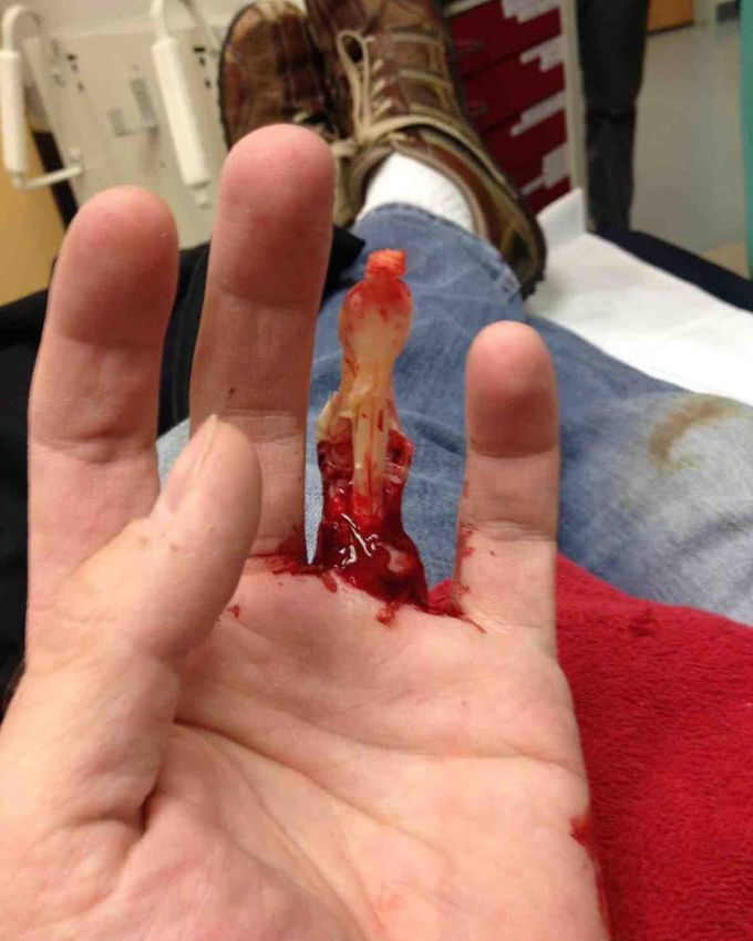 This is another case of finger degloving from going down a firemans pole. 