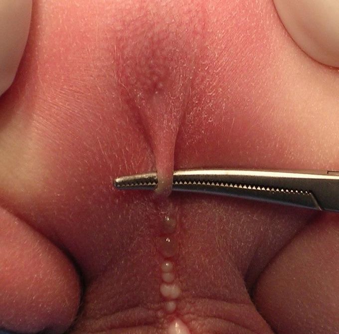 Pediatric Imperforate Anus (Anorectal Malformation)