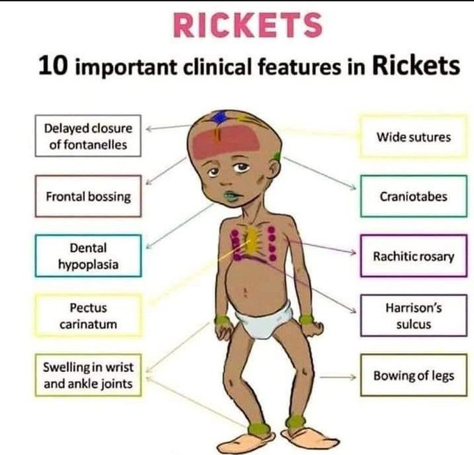 Rickets