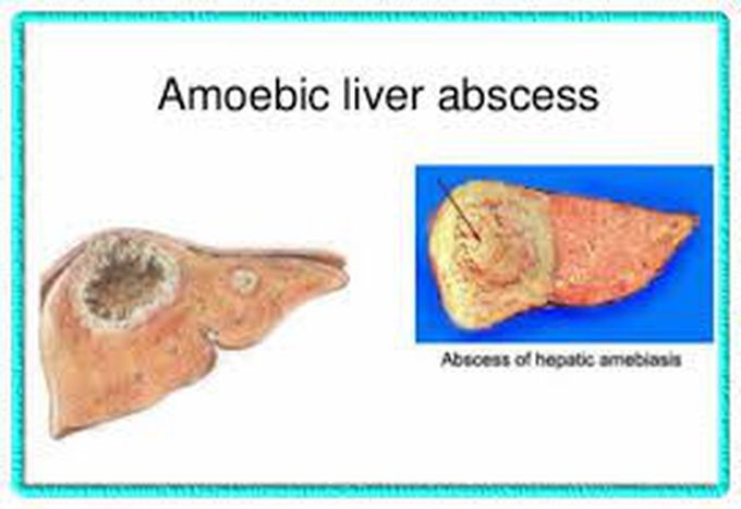 Amebic liver abcess