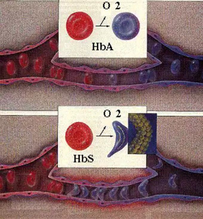 How Does Sickle Cell Cause Disease?