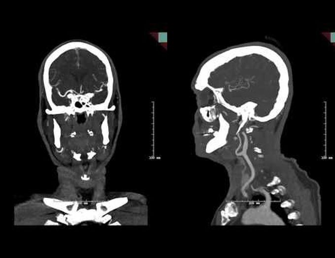 Endovascular mgmt of basilar artery occlusion secondary to fusiform aneurysm w intraluminal thrombus