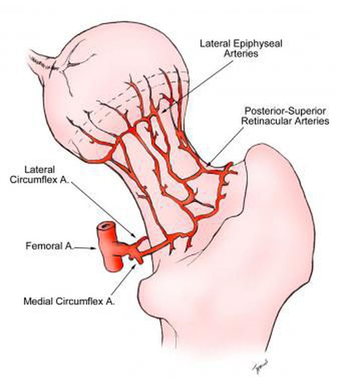Avascular necrosis due to damage to retinacular arteries
