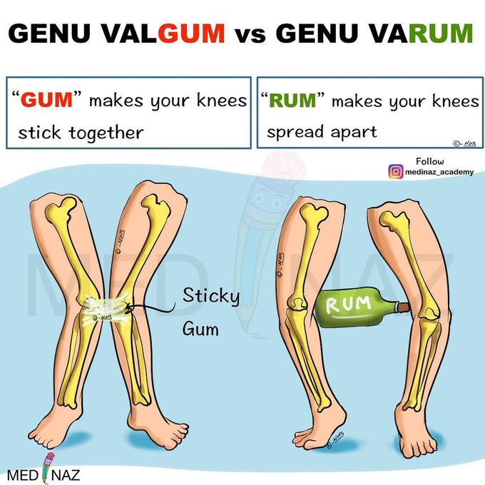 Comparing Genu Valgum Genu Varum