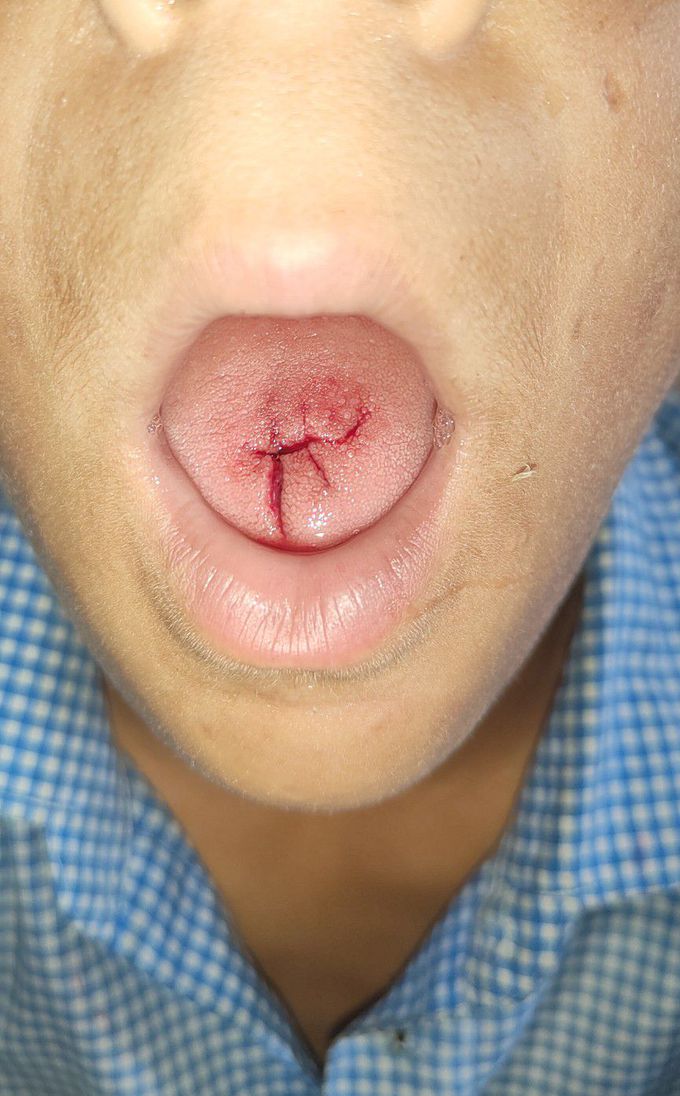 Trauma of a tongue due to tooth bite during playing at school.