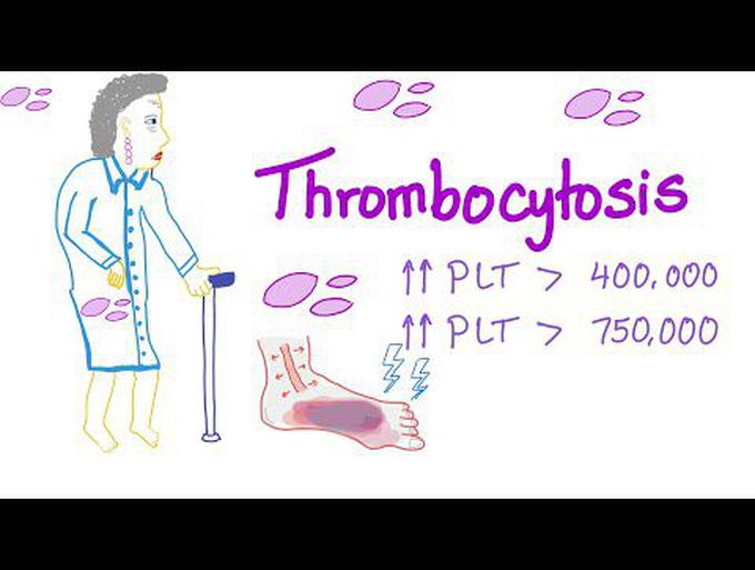 Thrombocytosis (primary and secondary)