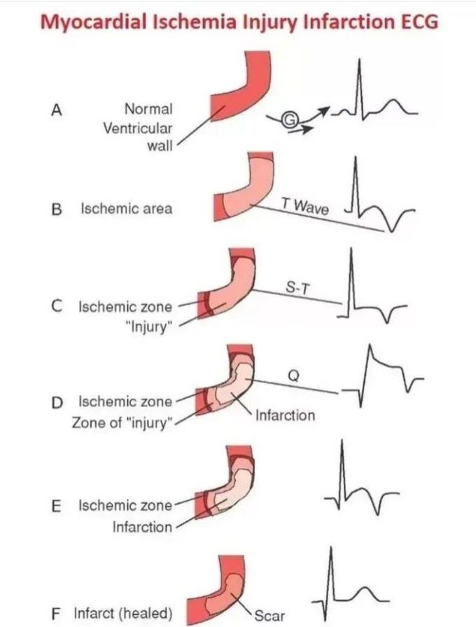 Myocardial Ischemia and ECG