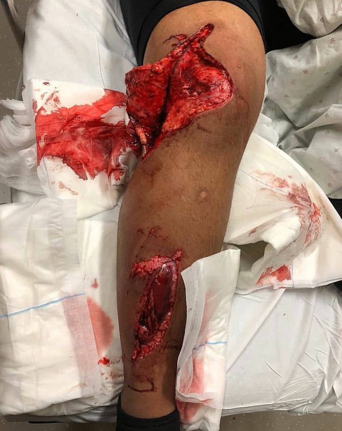 Motorcycle accident
