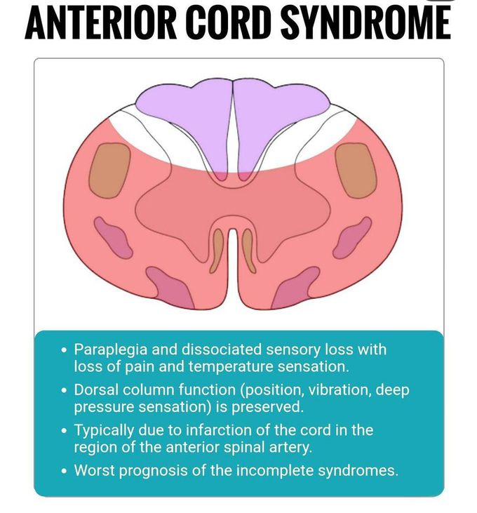 Anterior Cord Syndrome