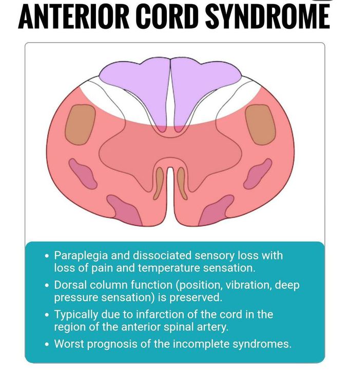 anterior cord syndrome