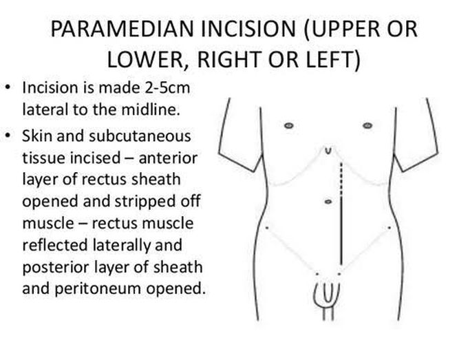 Paramedian incision