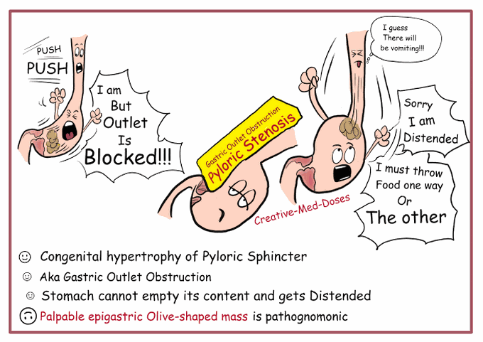 Hypertrophic Pyloric Stenosis