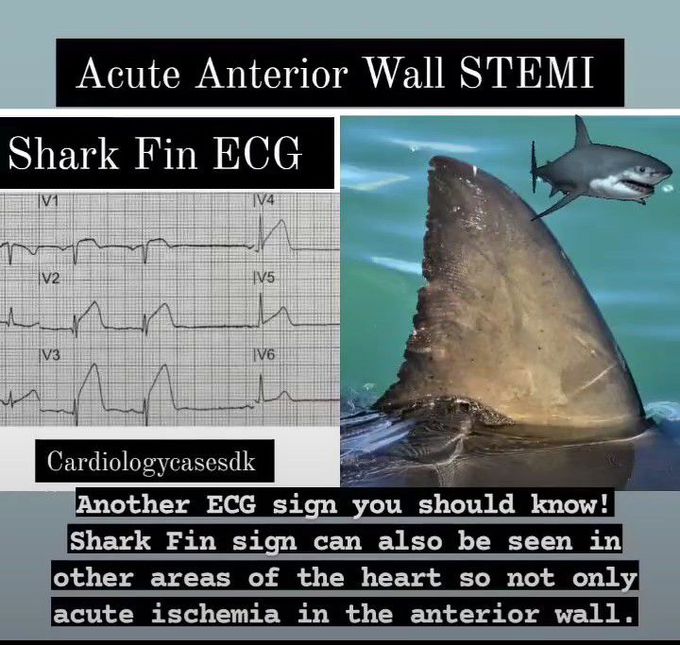 Shark Fin ECG