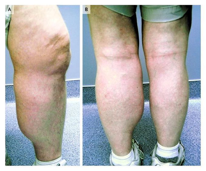 Baker's cyst