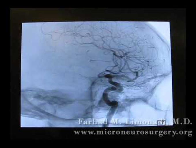 3D Cerebral Angiography