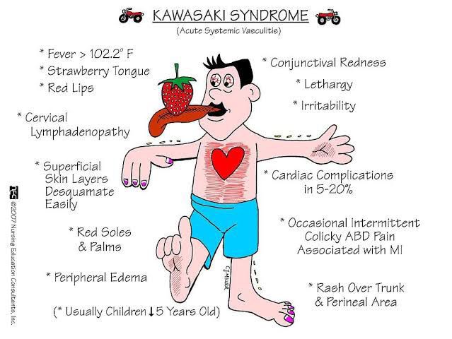 Kawasaki Syndrome - Medizzy