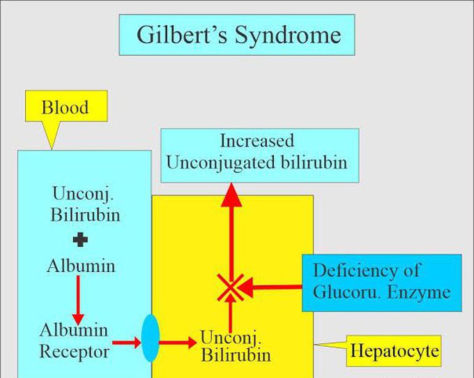 Gilberts syndrome