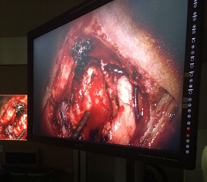 Clipping Aneurysm