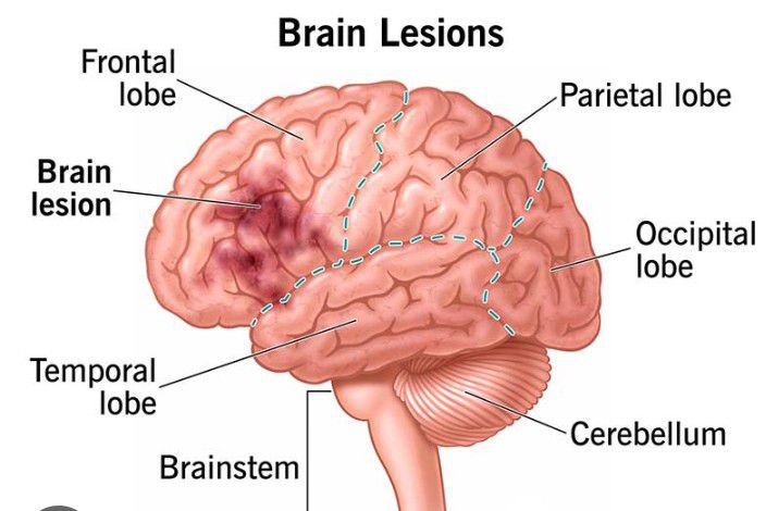 Brain Lesion MEDizzy