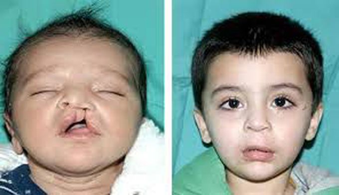 Causes of cleft lip
