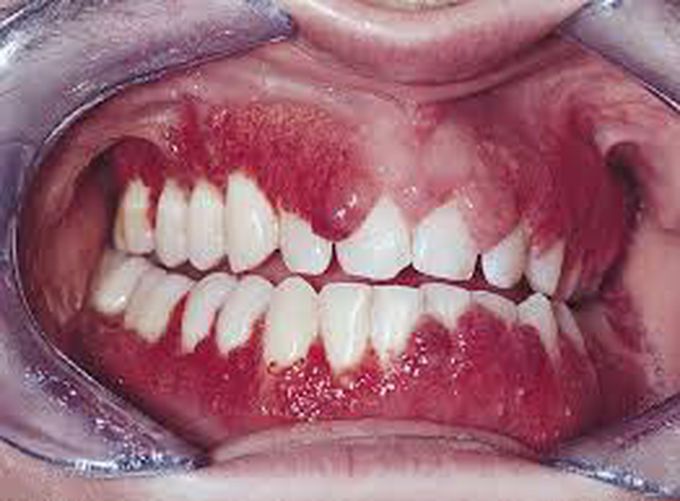 Treatment of strawberry gingivitis