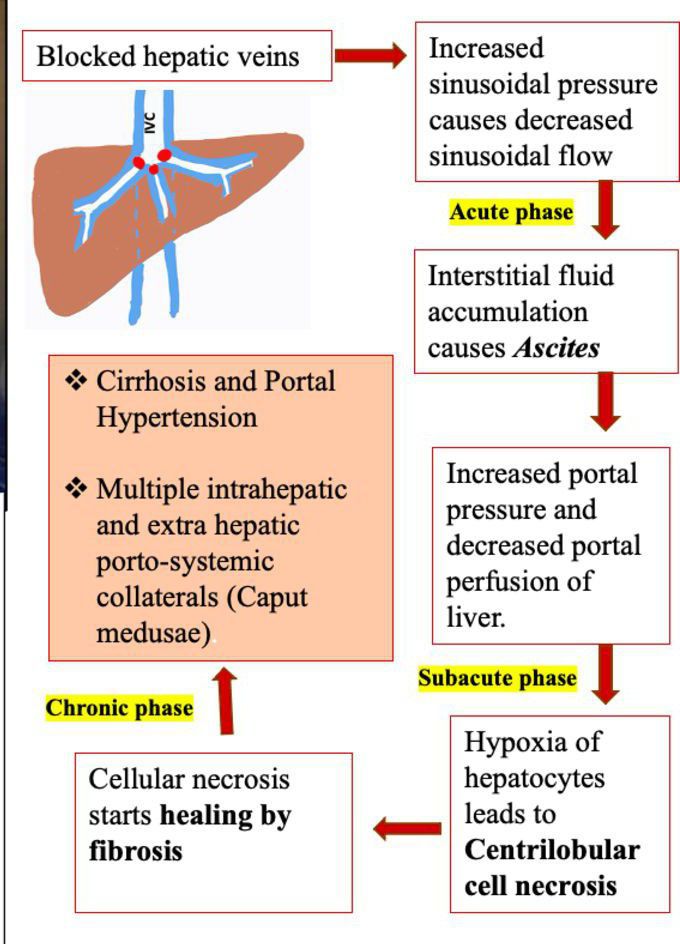 Portal Hypertension Caput Medusae