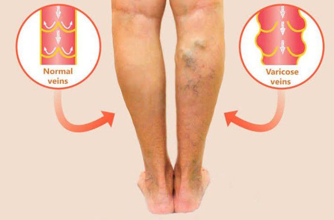 Cause of Varicose veins