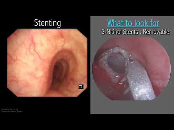 Mastering Bronchoscopy for Thoracic Surgery: Chapter 3