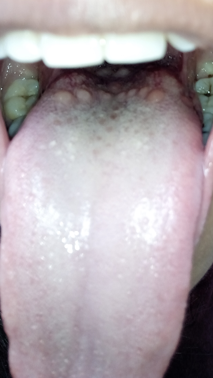 Is this circumvallate papillae or something else?