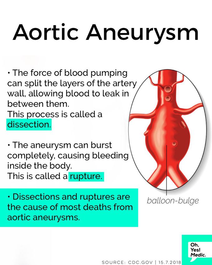 Continue: see my last post of Aortic Aneurysms