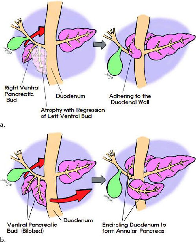 Annular Pancreas