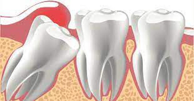 Causes of wisdom tooth impaction