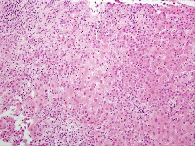 Acute Hepatitis