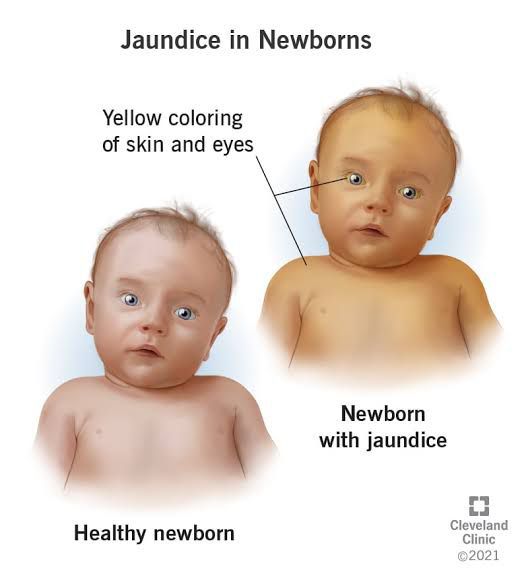 Neonatal Jaundice - MEDizzy
