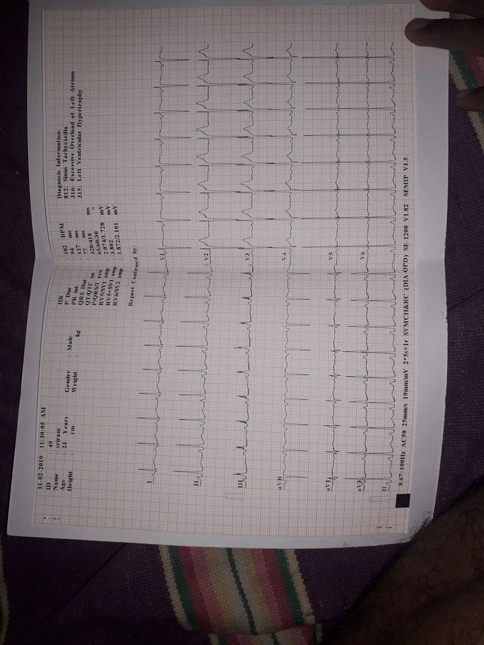 What are the reasons for the above impression in the ECG report for a 21yrs old boy