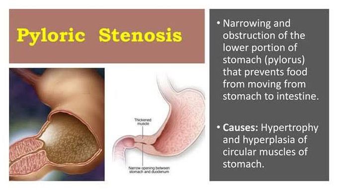 Pyloric stenosis causes