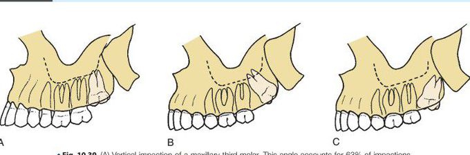 Maxillary impactions