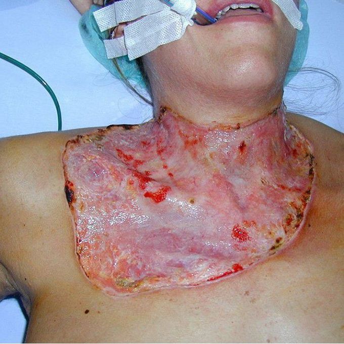 This is a 29-year-old previously healthy woman with pyoderma gangrenosum immediately after thyroidectomy.