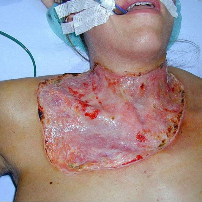 This is a 29-year-old previously healthy woman with pyoderma gangrenosum immediately after thyroidectomy.